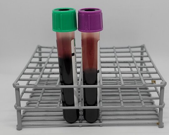Venøst fullblod fra heparin- eller EDTA-rør anbefales ved måling av 2-timers glukose. Foto: Noklus